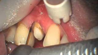 WATERLASE MD Closed Bony Crown Lengthening 95128 [upl. by Marder]