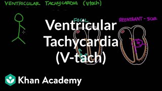 Ventricular tachycardia Vtach  Circulatory System and Disease  NCLEXRN  Khan Academy [upl. by Sidnee]