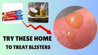 Want to Avoid Blisters Try These Home Remedies to Treat Burn Wound [upl. by Griffy594]