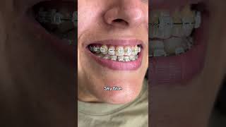 Braces Colors Before and After 8 weeks [upl. by Connor]