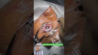 Contoura Vision Treatment eye eyetreatment eyesurgery eyehospita AHomeShorts [upl. by Mccall349]