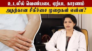 How to Cure Vitiligo  வெண்படை போக்குவது எப்படி  Samayam Tamil [upl. by Pathe]