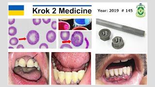 Krok 2 Medicine  Year 2019  145 Ministry of Public Health of Ukraine [upl. by Correy509]