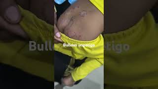 Bullous impetigopaeds clinicalpediatrics [upl. by Josi]