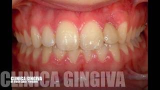 CLINICA GINGIVAIMPLANTE INCISIVO LATERALDR JAVIER GARCIA FERNANDEZ [upl. by Cortney]