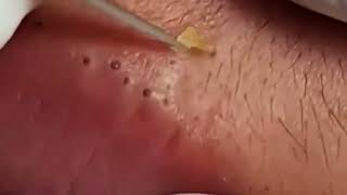 The Most Painful Blackhead Removal Video on Lips 2024 [upl. by Enelrac70]