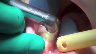 Pulpectomy on Lower Molar in Child Patient with YSGG iPlus Laser and no injection anesthesia [upl. by Virgilia429]