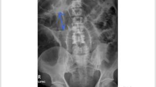 Small bowel obstruction [upl. by Ynattir]