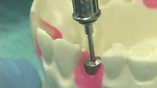 Placing Implant Abutments [upl. by Ellezig]