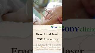 Fractional Laser CO2 Treatment Achieve Smooth amp Youthful Skin at BodyClinix [upl. by Neville125]