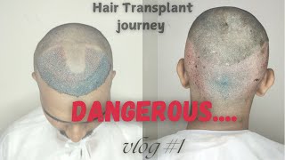 Hair Transplant journey day 3 [upl. by Etteloc]