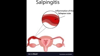 Biodescodificación  Salpingitis [upl. by Attenauq]