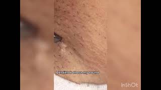 long Ingrown hair [upl. by Lunsford]