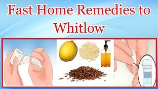 Fast Home Remedies to Whitlow [upl. by Oremodlab]