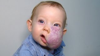 See 2YearOlds Incredible Transformation After Surgery To Remove Facial Tumor [upl. by Fiora]