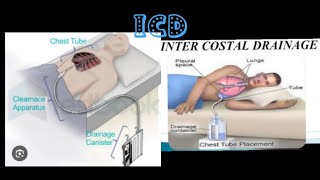 intercostal drainagerecurrent plueral effusionmbbsprocedure medicose Sudarshanlipane17 ⛑️⛑️🩺 [upl. by Siramed511]