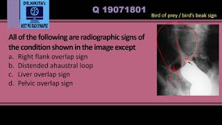 Sigmoid volvulus  Radiology signs [upl. by Lenehc]