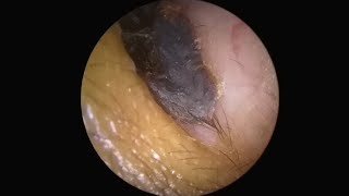 AMAZING EAR STONE REMOVAL YOU HAVE TO SEE THIS [upl. by Culliton]