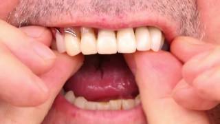 Partial Denture Video [upl. by Spain]