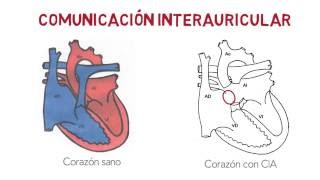 CIA  Comunicación interauricular [upl. by Aicnelav]