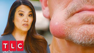 Squeezing Out a Swollen Jaw Lump  Dr Pimple Popper A Pimple Carol [upl. by Kinelski134]