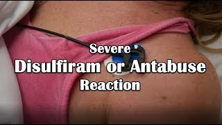 Disulfiram or Antabuse Reaction Emergency [upl. by Eseilenna]