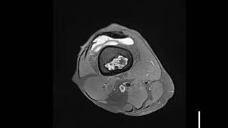 Bone infarction around knee joint [upl. by Aniroz]