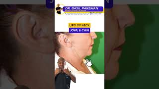 Lipo of neck chin and jawline [upl. by Einafit]