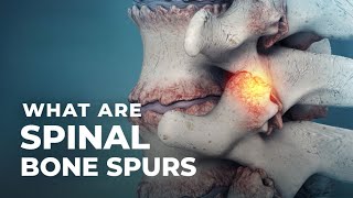 What Are Spinal Bone Spurs  Atlantic Spine Center [upl. by Steffen]