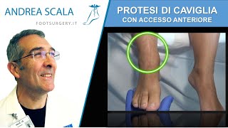 PROTESI DI CAVIGLIA CON ACCESSO ANTERIORE  Protesi di caviglia post intervento  Dott Andrea Scala [upl. by Noemys]