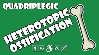 Heterotopic Ossification HO Explained  Quadriplegic C5C6C7 [upl. by Ahsito]