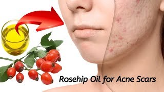 Rosehip Oil for Acne Scars  A Superfood for Your Skin [upl. by Eshman]