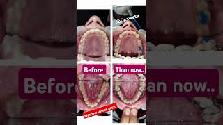 Crowded teeth narrow arch treatment Lingual arch applianceshorts trendingshorts Drswetakaushik [upl. by Outlaw]