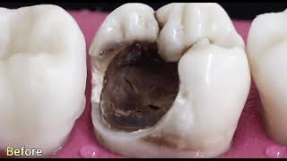 Root canal treatment procedure and a gold crown [upl. by Aniral899]