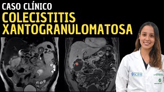 Caso clínico 110 Colecistitis xantogranulomatosa [upl. by Kiryt]