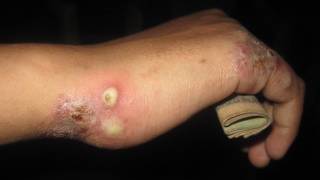 Home Treatment For Scabies [upl. by Mauricio]