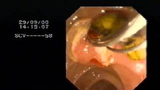 ERCP and bile duct stone extraction [upl. by Aikaj29]