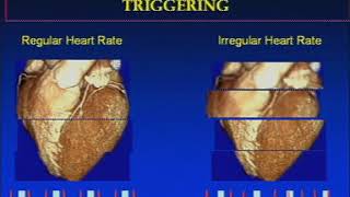 The Basics of Coronary CT Angiography [upl. by Xuaeb417]