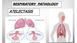 Respo pathology  ATELECTASIS and its types atelectasis copd pathology [upl. by Philoo]