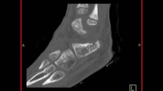 Musculoskeletal Calcaneus fracture Sagittal [upl. by Feerahs]