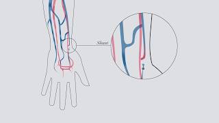 Understanding hemodialysis [upl. by Wrdna190]