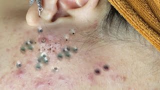 Blackheads amp Acne Treatment 24052024 Part 10 blackhead whitehead acne blackheadremoval [upl. by Adnohs]