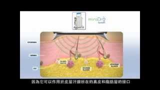 miradry微舒淨 微波熱能除汗術簡介風華整形外科診所 [upl. by Tocs]