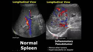 Spleen Ultrasound Normal Vs Abnormal Image Appearances Comparison  Splenic Pathologies On USG [upl. by Alage]