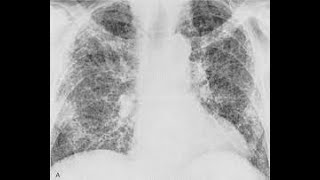 FIBROSIS PULMONAR CAUSAS SÍNTOMAS DATOS CLÍNICOS IMÁGENES Y TRATAMIENTO [upl. by Teerell]