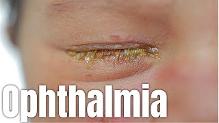 Ophthamia Neonatorum  Newborn Eye Infection Explained [upl. by Mazlack982]