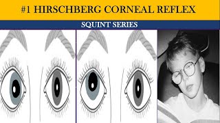 Phoria vs tropia  types of squint  Hirschberg Corneal Reflex Test HCRT  Squint series [upl. by Hakceber]