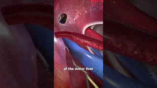 How Liver Transplants Work 🤔shorts shortvideo reels youtubeshorts [upl. by Hsu]