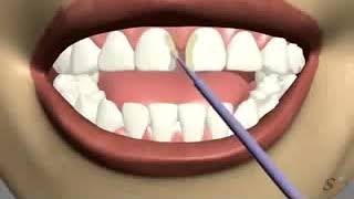 gap closure by dental veneers [upl. by Nerdna]