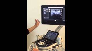 Echografie van de inguinale hernia  advanced course MSU [upl. by Buttaro208]